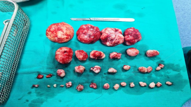 Hastanın rahminden 38 miyom çıktı