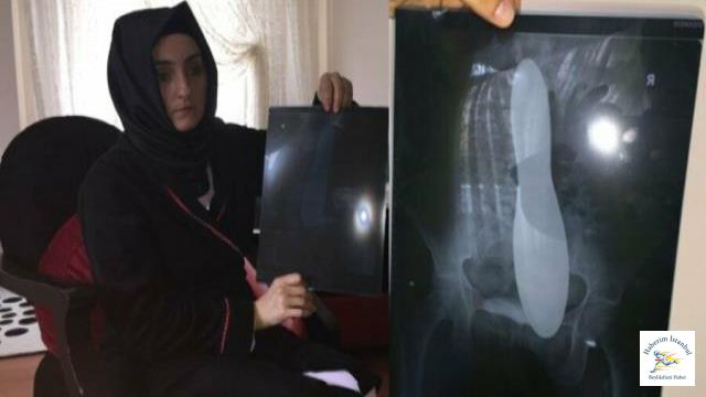 Kadın hastanın karnında mala unutuldu!