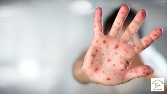 DSÖ O Hastalığa Yeni İsim Arıyor