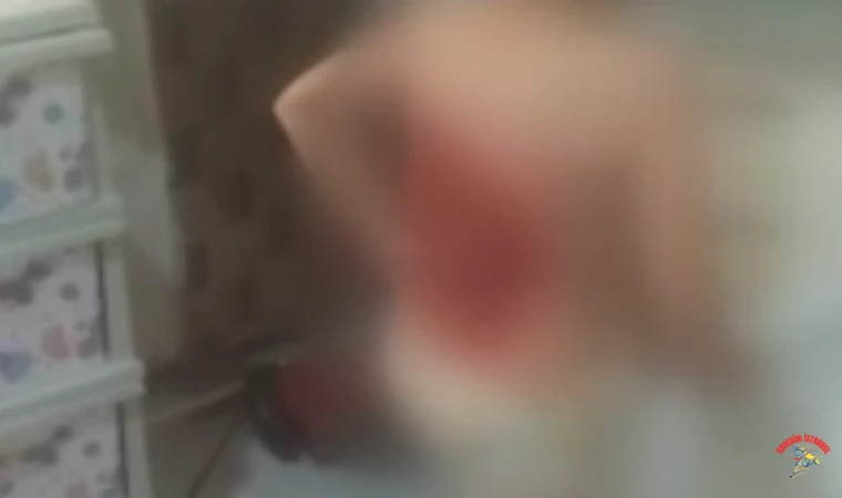Arnavutköy'de 12 yaşındaki çocuğun sırtını kolonya dökerek yaktılar!