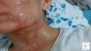 Sivilcelerinden kurtulmak istedi! Yüzü alev aldı